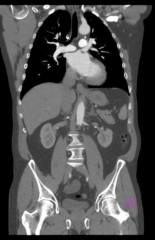 Aortectomy and axillary-bifemoral bypass (Radiopaedia 28303-28545 C 50).jpg