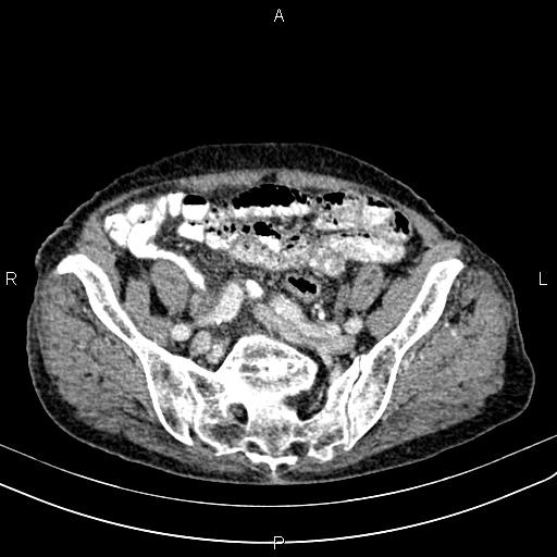 Aortic aneurysm and Lemmel syndrome (Radiopaedia 86499-102554 A 62).jpg