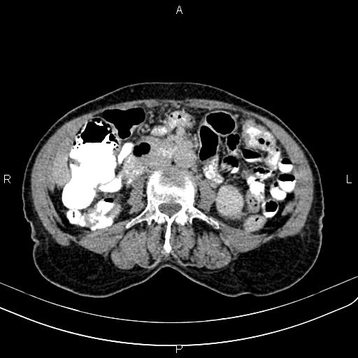 Aortic aneurysm and Lemmel syndrome (Radiopaedia 86499-102554 Axial C+ delayed 41).jpg