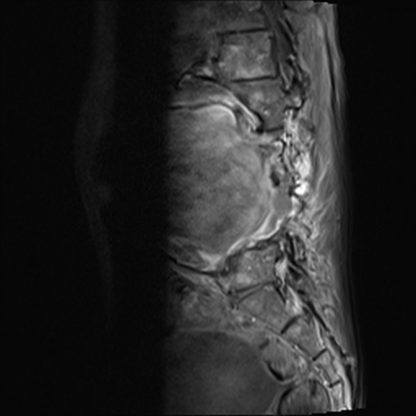 File:Aortic aneurysm with spinal destruction (Radiopaedia 42301-45409 Sagittal T1 fat sat 22).jpg
