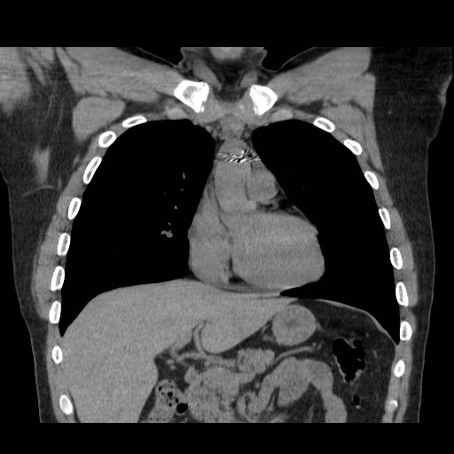 File:Aortic arch stent (Radiopaedia 30030-30595 Coronal non-contrast 3).jpg
