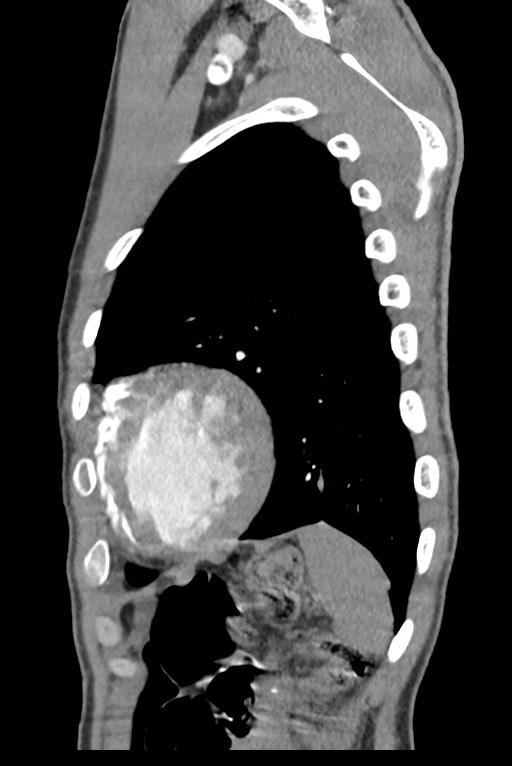 Aortic coarctation with aneurysm (Radiopaedia 74818-85828 B 133).jpg
