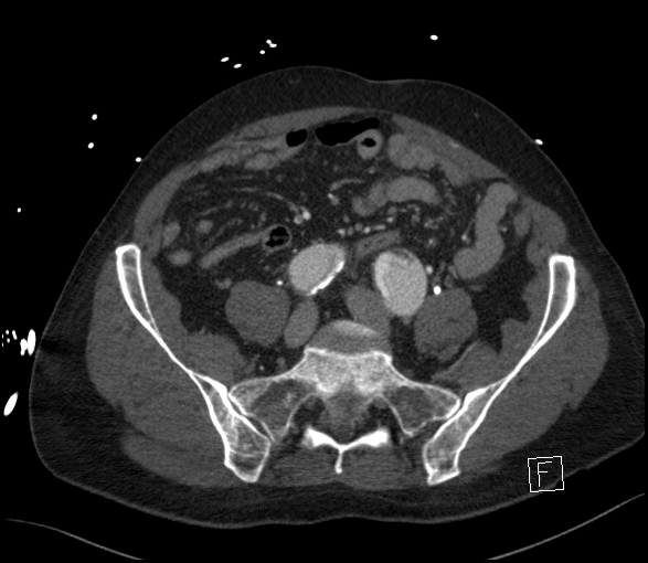 Aortic dissection (CTPA) (Radiopaedia 75506-86750 E 108).jpg