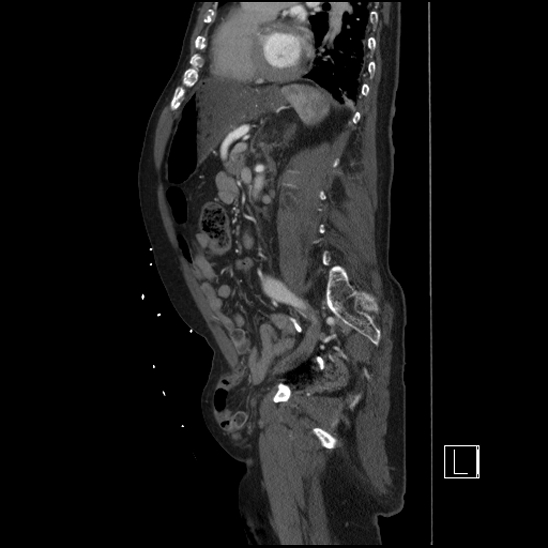 Aortic dissection (CTPA) (Radiopaedia 75506-86750 G 70).jpg