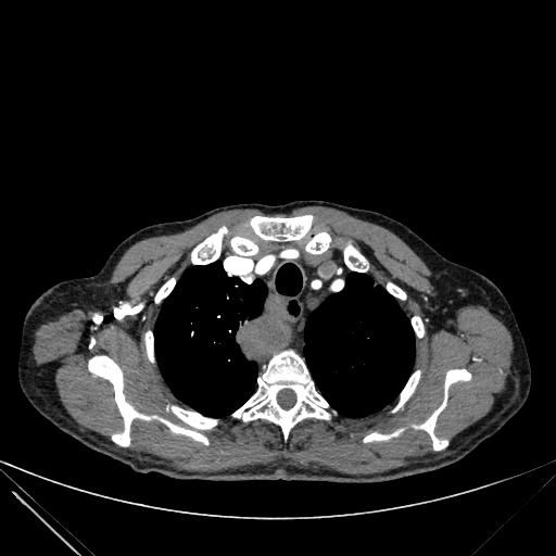 Aortic dissection (Radiopaedia 27466-27665 C+ arterial phase 4).jpg