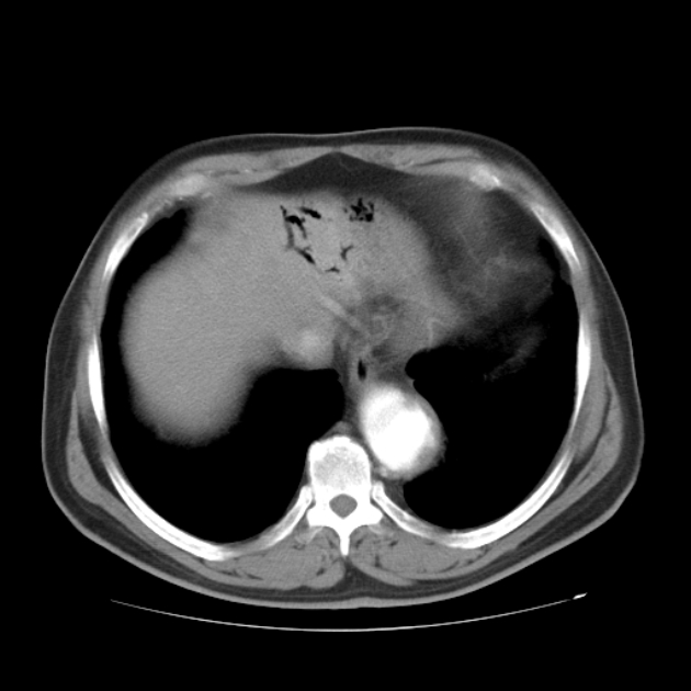 Aortic dissection (Radiopaedia 44411-48061 C 21).jpg