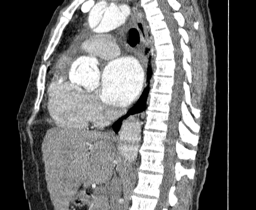 File:Aortic dissection - Stanford A -DeBakey I (Radiopaedia 28339-28587 C 27).jpg