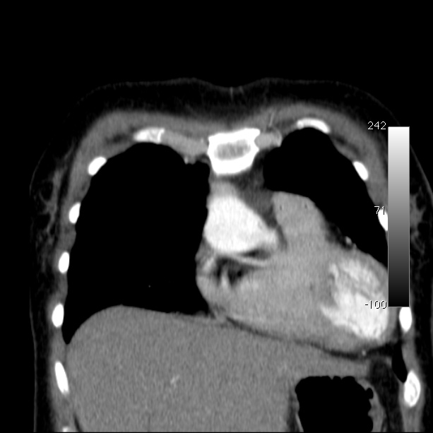 Aortic dissection - Stanford type A (Radiopaedia 29247-29659 B 15).jpg