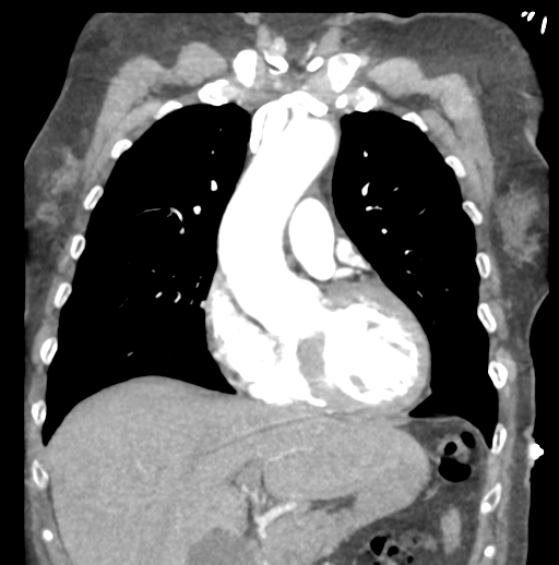File:Aortic dissection - Stanford type B (Radiopaedia 50171-55512 B 30).png