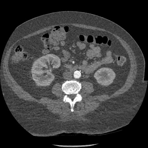 Aortic dissection - Stanford type B (Radiopaedia 88281-104910 A 125).jpg