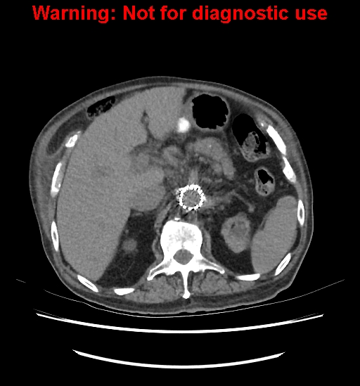 File:Aortic graft infection (Radiopaedia 44979-48907 Axial non-contrast 35).jpg