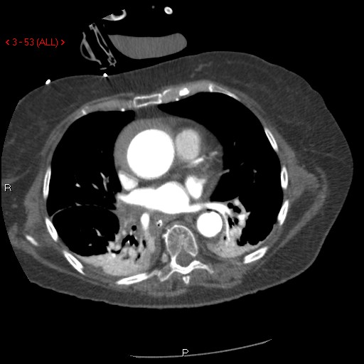 Aortic intramural hematoma (Radiopaedia 27746-28001 A 53).jpg