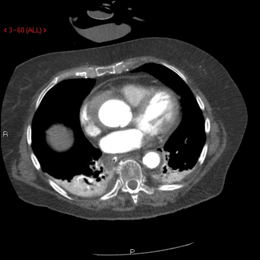 Aortic intramural hematoma (Radiopaedia 27746-28001 A 60).jpg