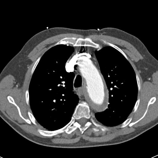 Aortic intramural hematoma (Radiopaedia 31139-31838 B 28).jpg