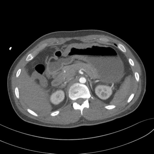 File:Aortic transection (Radiopaedia 29890-30405 A 103).jpg