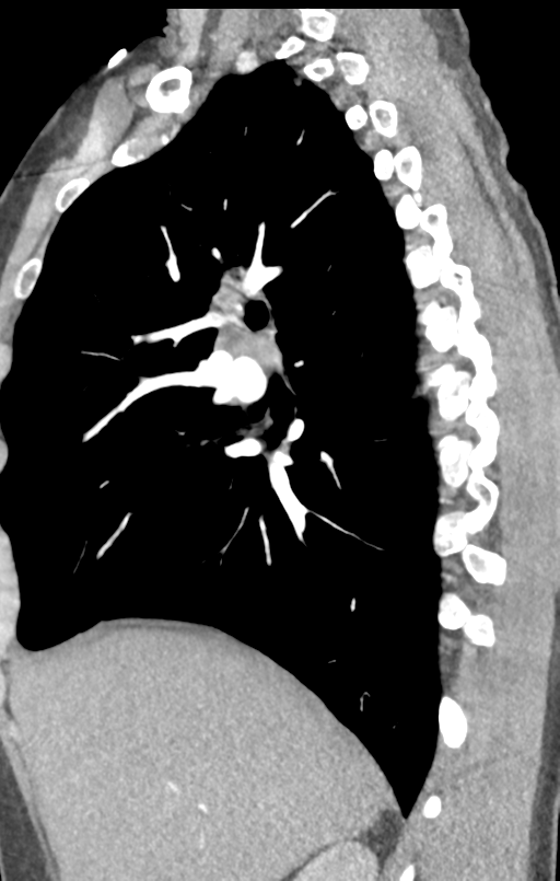 Aortic valve non-coronary cusp thrombus (Radiopaedia 55661-62189 C+ arterial phase 43).png