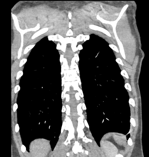 Aortic valve non-coronary cusp thrombus (Radiopaedia 55661-62189 C 65).png