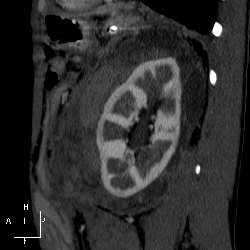Aorto-left renal vein fistula (Radiopaedia 45534-49628 C 56).jpg