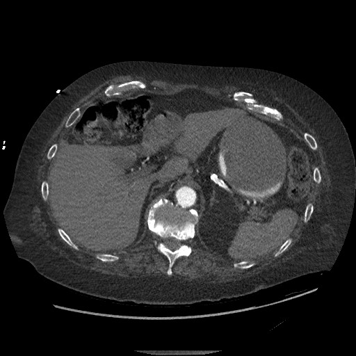 Aortoesophageal fistula with endovascular repair (Radiopaedia 73781-84592 Axial C+ CTPA 173).jpg