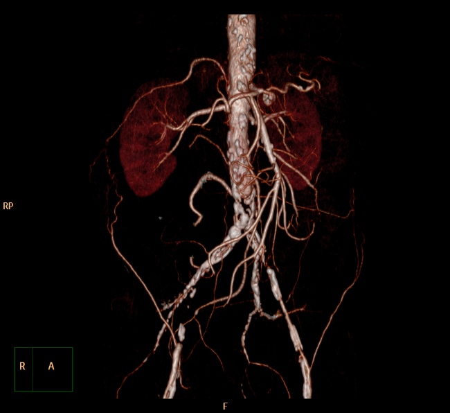 File:Aortoiliac occlusive disease (Radiopaedia 32134-33076 VR C+ arterial phase 2).jpg