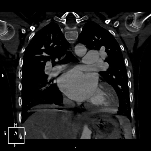 File:Aortopulmonary septal defect (Radiopaedia 41990-45013 Coronal C+ CTPA 36).jpg