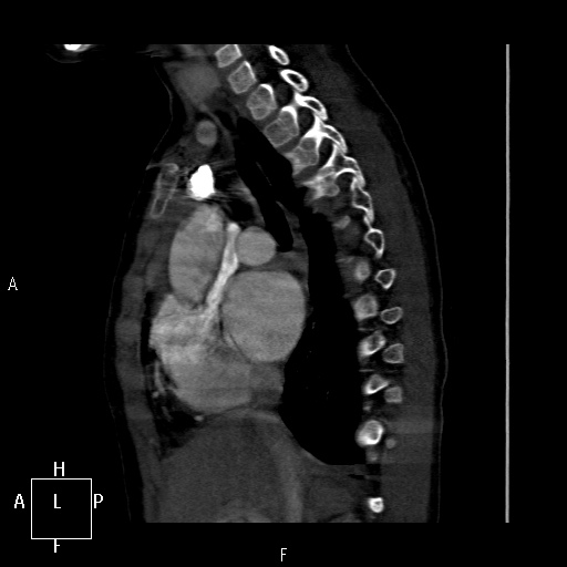 File:Aortopulmonary septal defect (Radiopaedia 41990-45013 Sagittal C+ CTPA 34).jpg