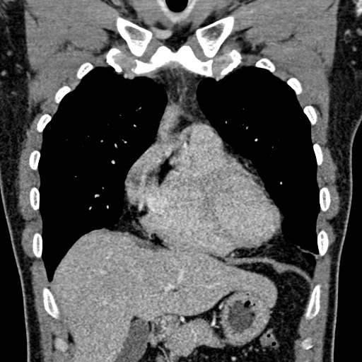 File:Apical lung mass mimic - neurogenic tumor (Radiopaedia 59918-67521 B 47).jpg