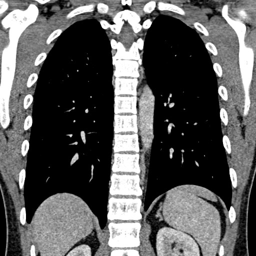 Apical lung mass mimic - neurogenic tumor (Radiopaedia 59918-67521 B 78).jpg