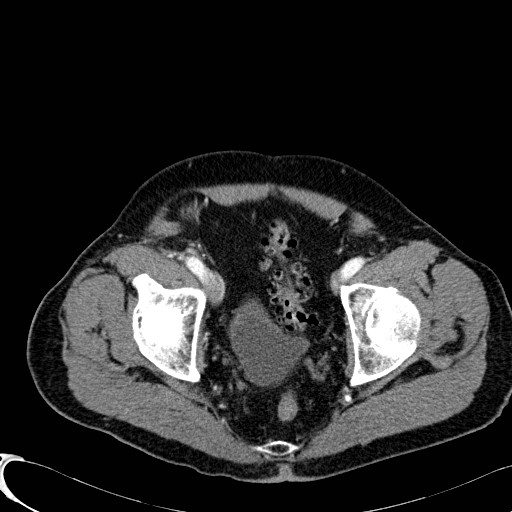 File:Appendiceal adenocarcinoma complicated by retroperitoneal abscess (Radiopaedia 58007-65039 B 128).jpg