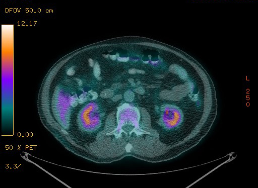 Appendiceal adenocarcinoma complicated by retroperitoneal abscess (Radiopaedia 58007-65041 Axial PET-CT 124).jpg