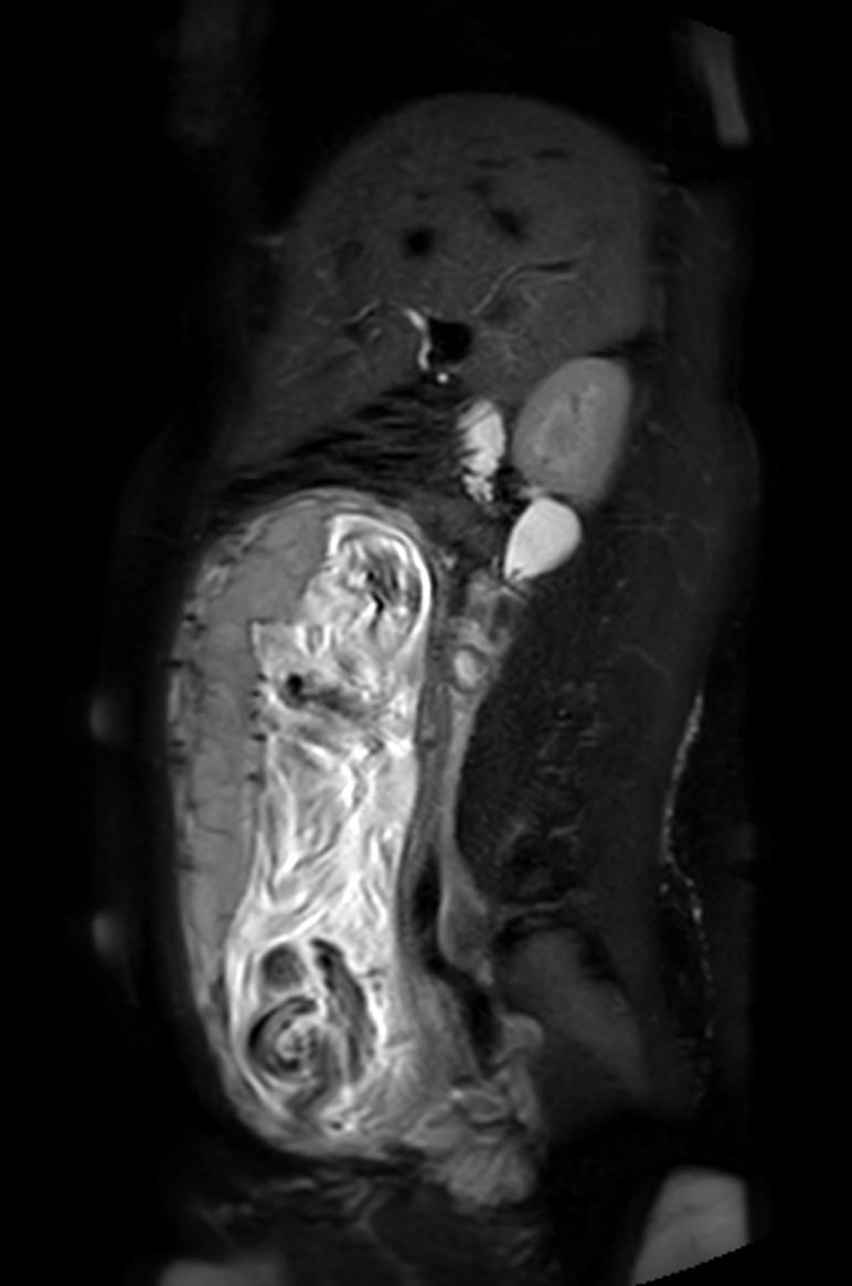 Appendicitis in gravida (MRI) (Radiopaedia 89433-106395 Sagittal T2 SPAIR 38).jpg