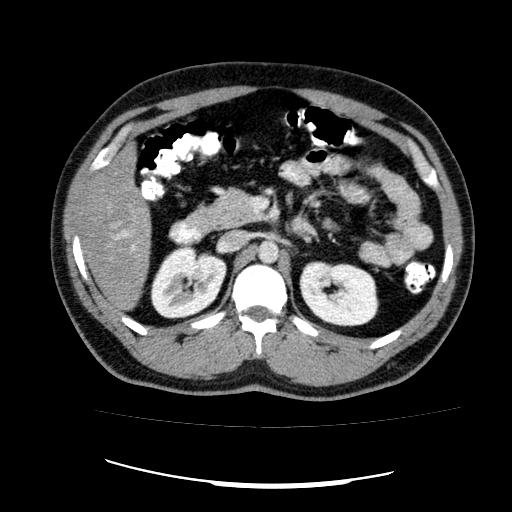 File:Appendicitis with diverticulosis (Radiopaedia 47693-52383 Axial C+ 49).jpg