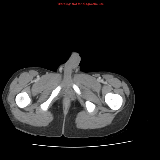 File:Appendicitis with phlegmon (Radiopaedia 9358-10046 A 75).jpg