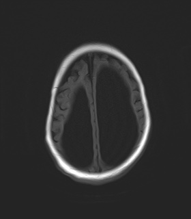 File:Aqueductal stenosis (Radiopaedia 73974-84802 Axial T1 20).jpg