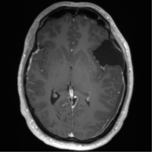 Arachnoid cyst with subdural hematoma (Radiopaedia 85892-101743 Axial T1 C+ 44).png