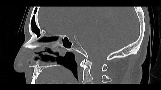 Arcuate foramen (Radiopaedia 89833-106944 Sagittal bone window 53).jpg