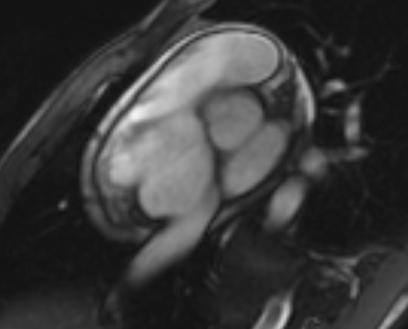 Arrhythmogenic right ventricular cardiomyopathy (Radiopaedia 69564-79464 short axis cine 279).jpg