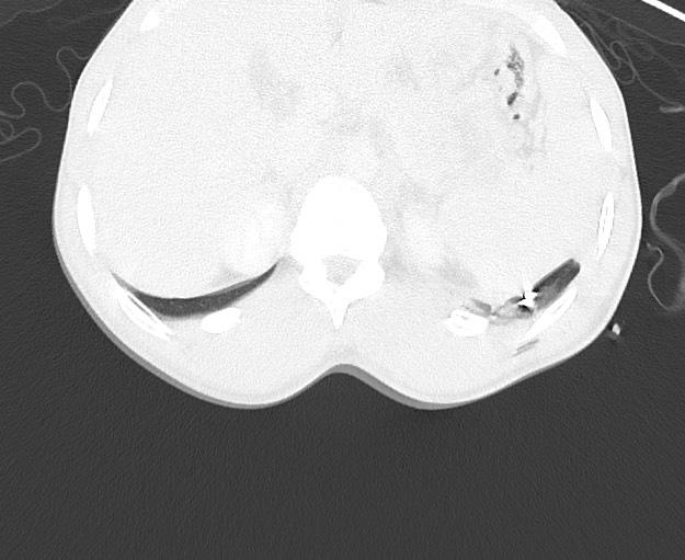 File:Arrow injury to the chest (Radiopaedia 75223-86321 Axial lung window 106).jpg