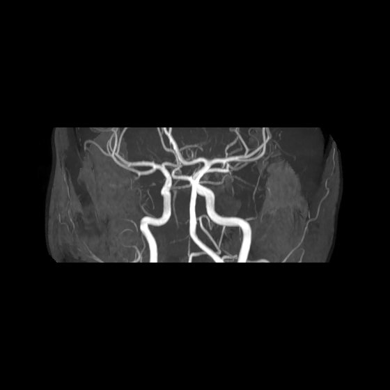 File:Artery of Percheron infarct (Radiopaedia 40966-43676 G 36).jpg