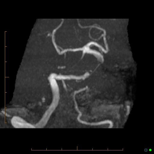 File:Artifactual basilar artery stenosis due to metallic stent (Radiopaedia 31206-31922 3D MIP 4).jpg