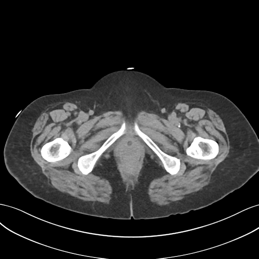 File:Ascending cholangitis (Radiopaedia 39068-41253 Axial non-contrast 73).png
