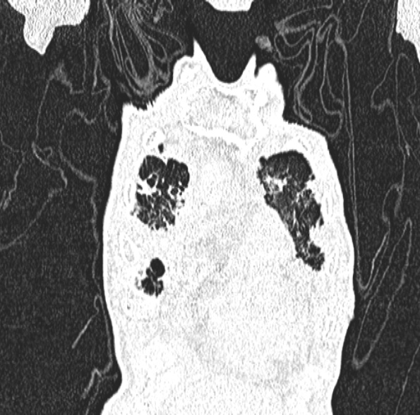 Aspergilloma- with Monod sign (Radiopaedia 44737-48532 Coronal lung window 134).jpg