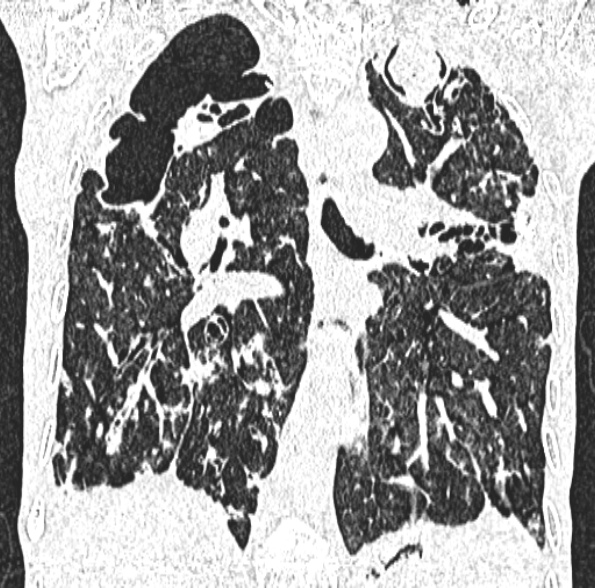 Aspergilloma- with Monod sign (Radiopaedia 44737-48532 Coronal lung window 270).jpg