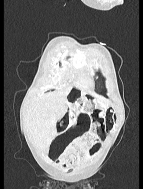 Asplenia syndrome (Radiopaedia 73083-83792 Coronal lung window 9).jpg