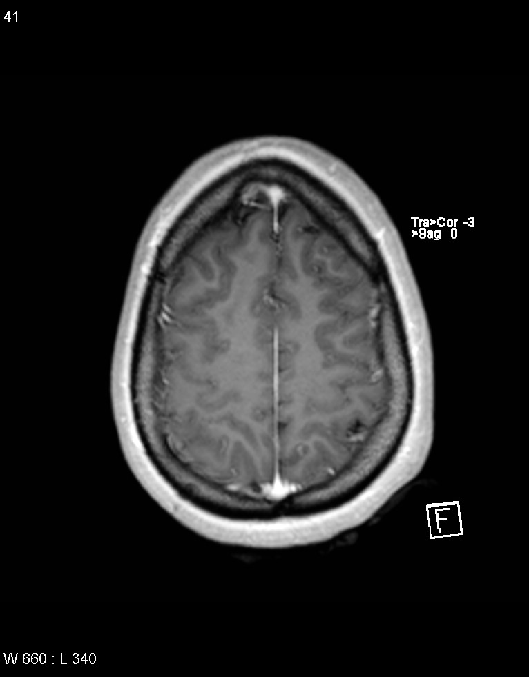 Astroblastoma (Radiopaedia 39792-42218 Axial T1 C+ 40).jpg