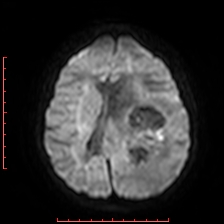 Astroblastoma (Radiopaedia 74287-85162 Axial DWI 62).jpg