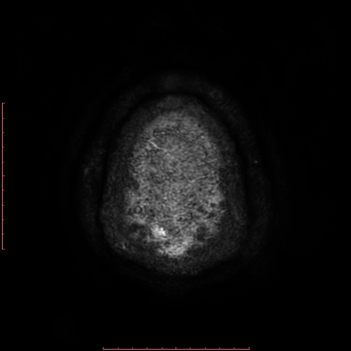 Astrocytoma NOS - cystic (Radiopaedia 59089-66384 Axial SWI 75).jpg