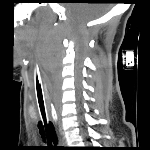 File:Atlanto-occipital dislocation (Radiopaedia 44648-48412 A 13).jpg