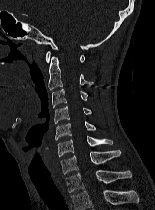 Atlantoaxial subluxation (Radiopaedia 44681-48450 Sagittal bone window 83).jpg