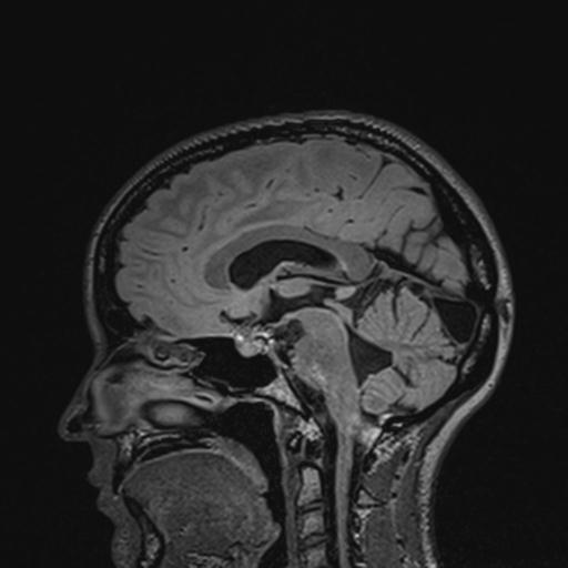 Atretic encephalocoele with inferior vermis hypoplasia (Radiopaedia 30443-31108 Sagittal FLAIR 82).jpg